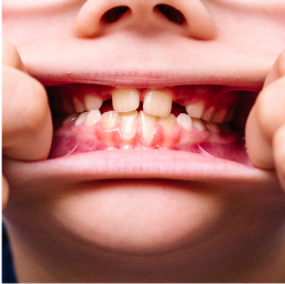 Bite Down (All Teeth)